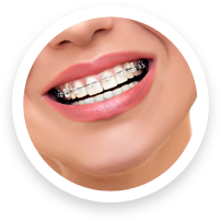 braces-faq-icon