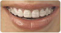 Clear Ceramic Braces