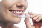 Invisalign Braces