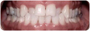 invisalign-frame4