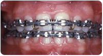 Metal Braces Wellington Florida FL