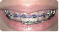 metal_braces