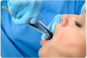Extractions During Orthodontic Treatment While Living In The Boca Raton FL Area