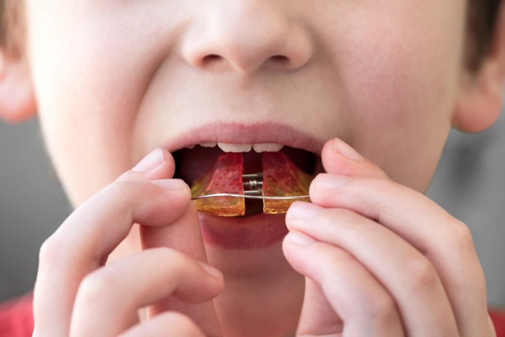 child with retainers