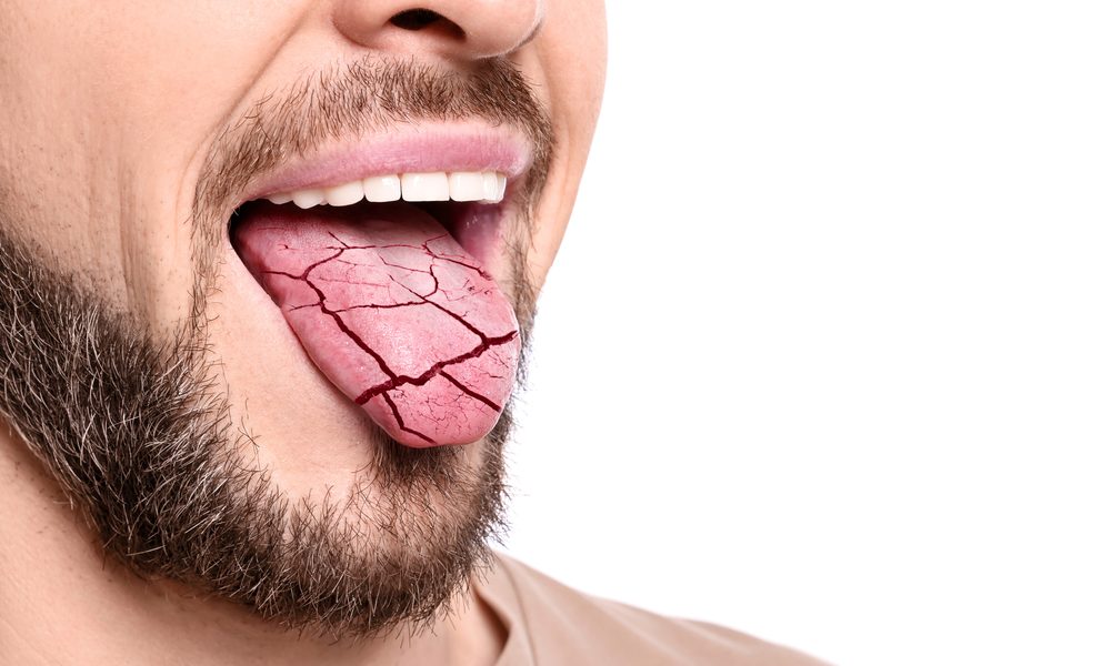 Man with dry mouth showing cracked tongue