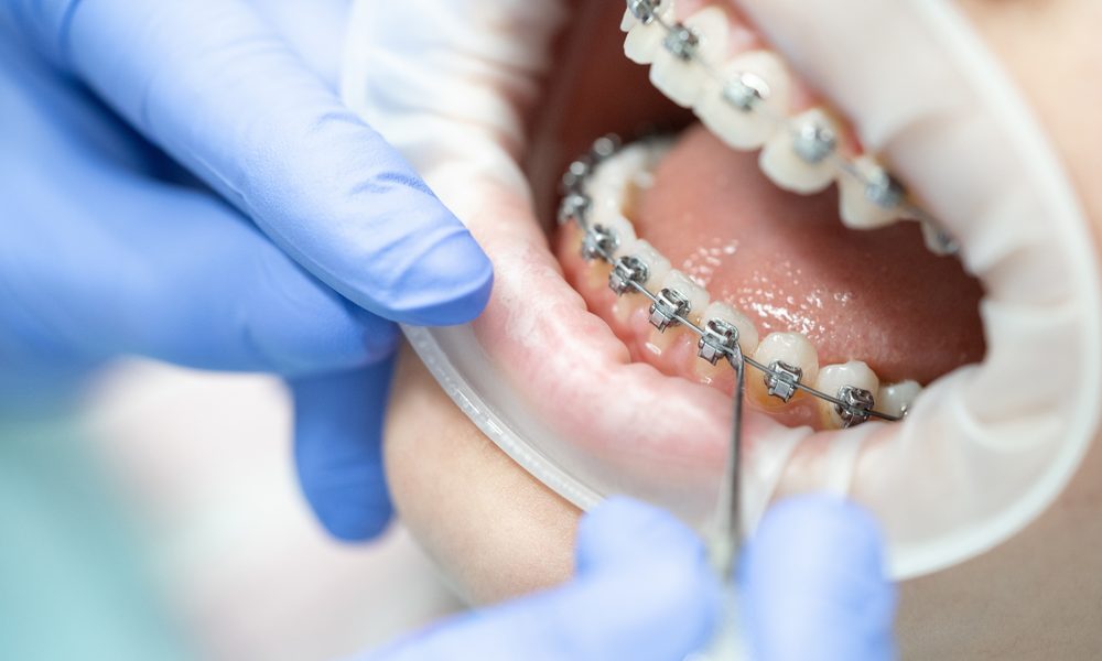 Orthodontist in blue gloves adjusting metal braces to treat and prevent white spots on teeth