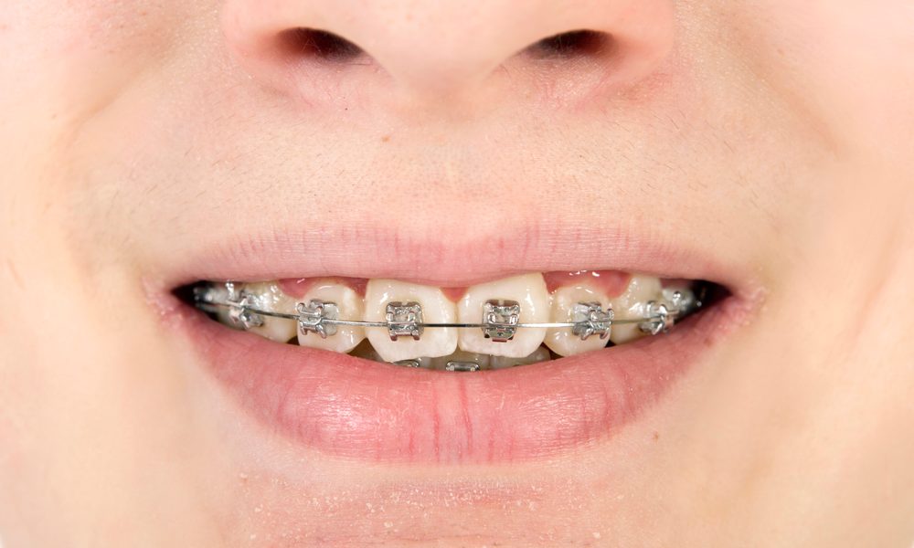 Close-up of white spot lesions on teeth caused by ceramic braces during orthodontic treatment
