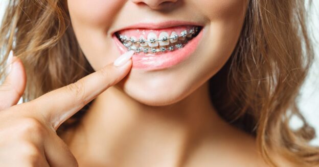 Young woman pointing to white spots on teeth with metal braces during orthodontic treatment
